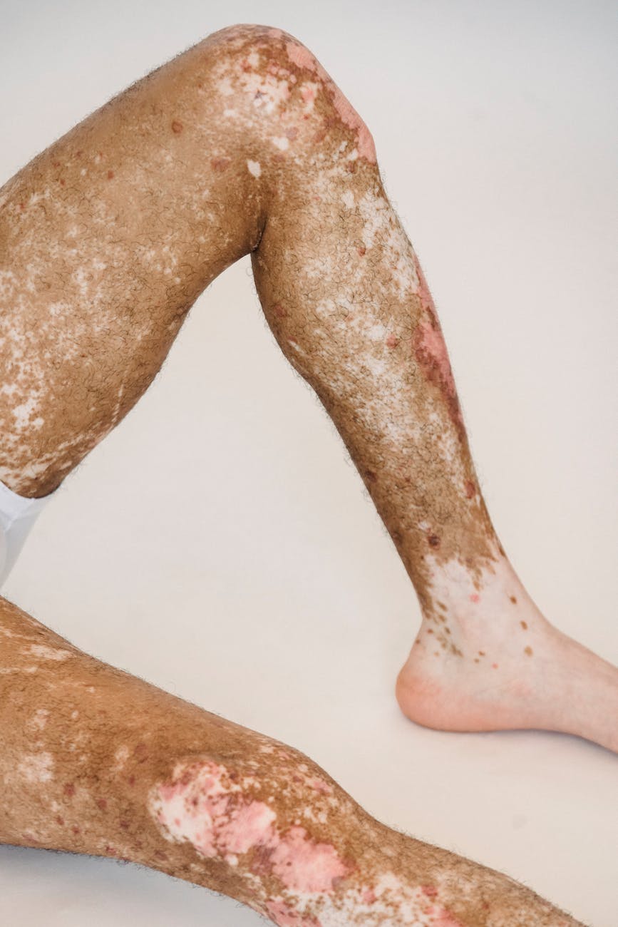 crop faceless man with vitiligo lying on white floor